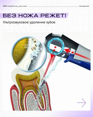 Пьезохирургия: меньше травм, быстрее заживление.